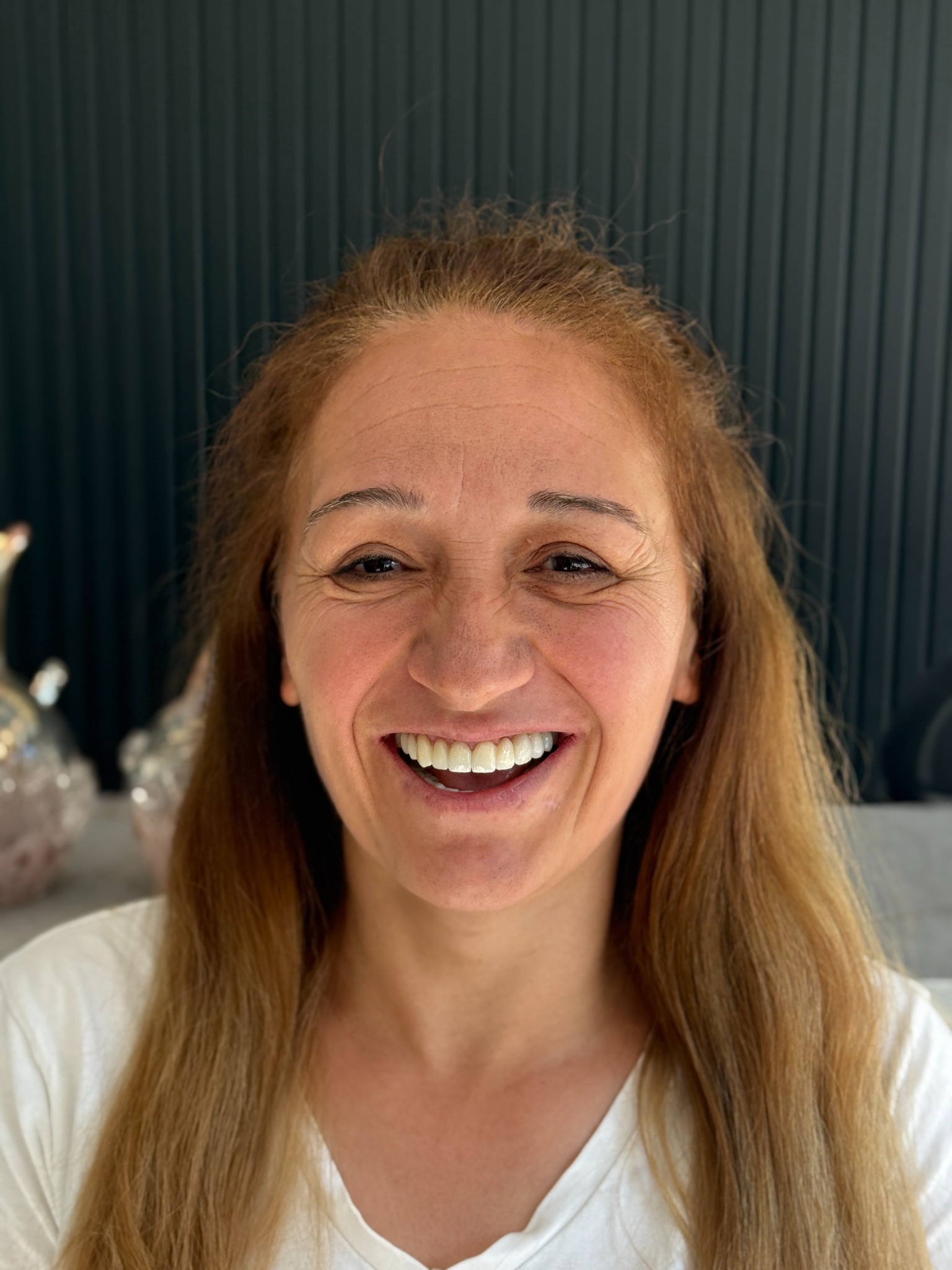 RY Akıncı dental treatment final result 12